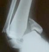 anklefracture