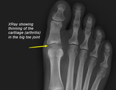 Rheumatoid arthritis radiology foot - cspl.hu