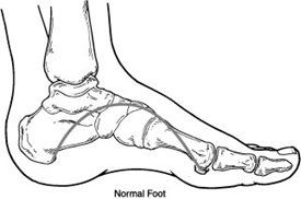 charcot foot