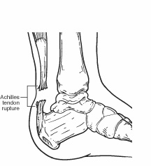 achilles tendon