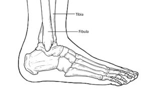 ankle fractures