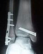 ankle fractures