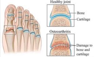 arthritis