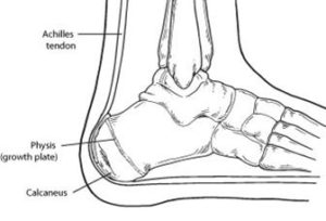 calcaneal apophysitis