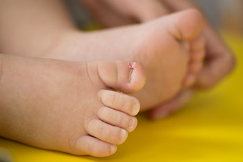 childrens-ingrown-nails