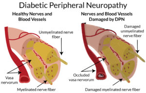 diabetic peripheral neuropathy