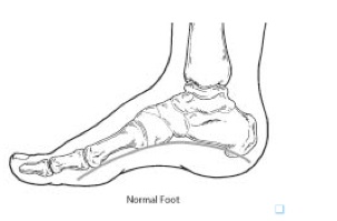 cavus foot