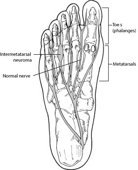 neuromas