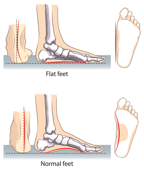 pediatric flatfoot