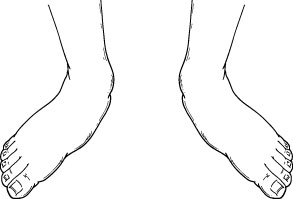 pediatric flatfoot