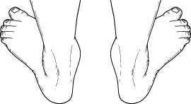 pediatric flatfoot