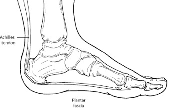 plantar fasciitis