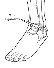 ankle sprain