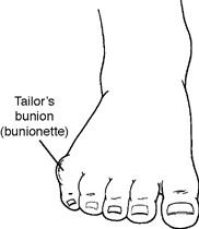 bunions