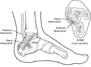 orthotics