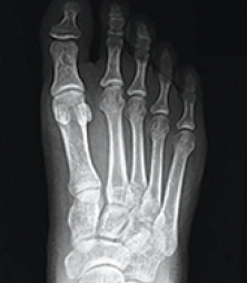 xray of bunion