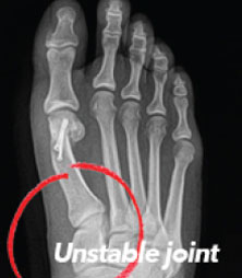 xray of bunion