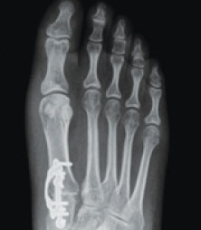 xray of bunions