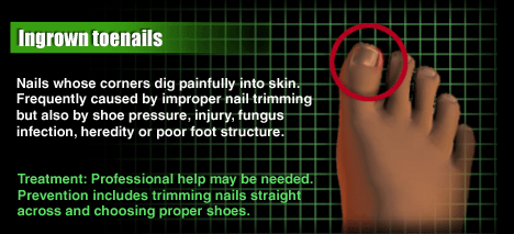 The Dangers of Ingrown Toenails: Washington Foot & Ankle Sports
