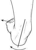 Flexible Flatfoot - Highlands Foot & Ankle - Waco Podiatrist